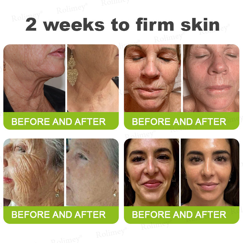 🇨🇦 Proudly Formulated & Shipped from Canada🍁Rolimey® Botox & Vita-A Retinol Shot Wrinkle-Lift Tightening Cream Last Day Promotion: 50% OFF