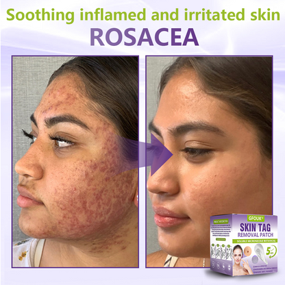 𝐎𝐟𝐟𝐢𝐜𝐢𝐚𝐥 𝐒𝐭𝐨𝐫𝐞 🇨🇦 |🍁💖💕GFOUK® Soluble Microneedle Botanical Skin Tag Removal Patch