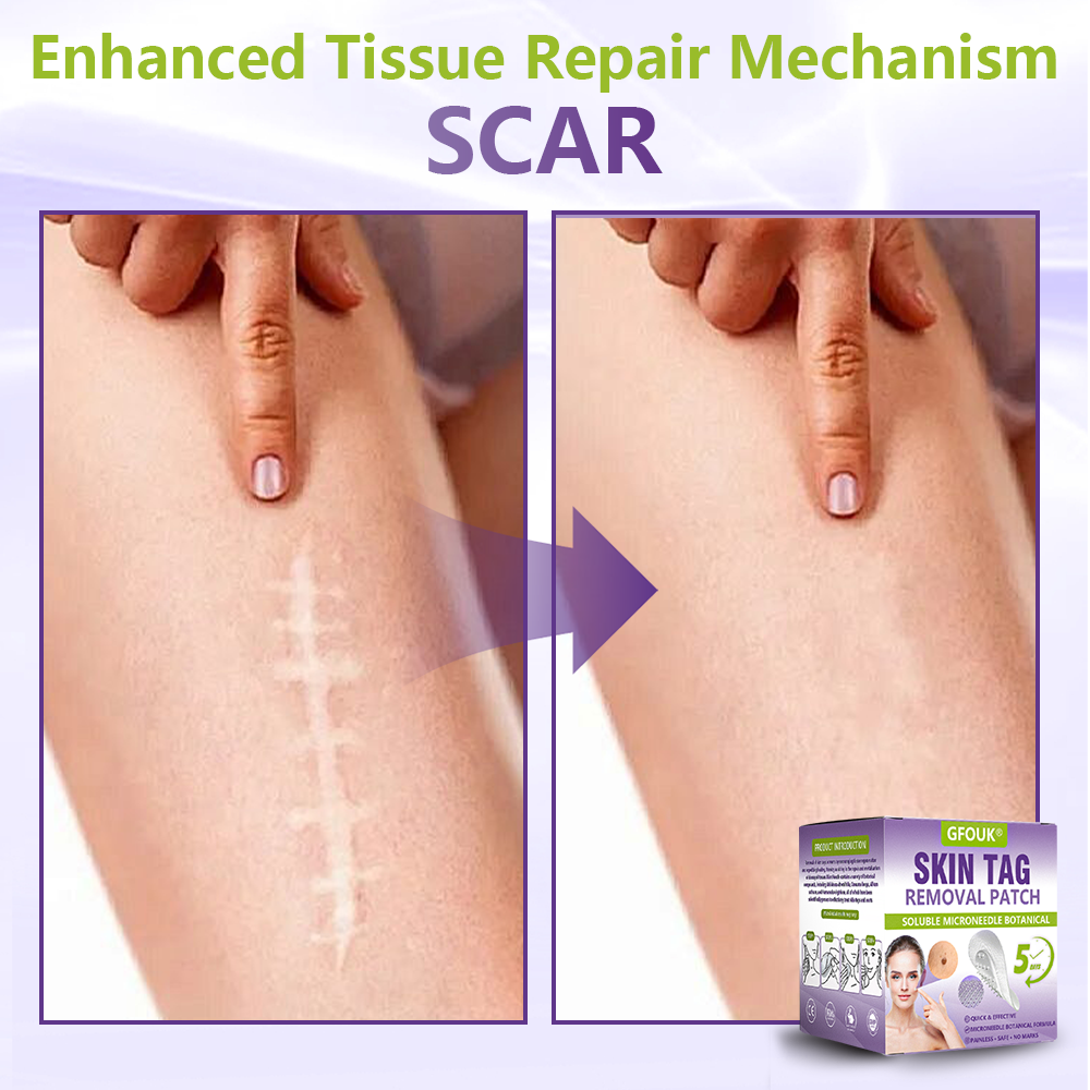 𝐎𝐟𝐟𝐢𝐜𝐢𝐚𝐥 𝐒𝐭𝐨𝐫𝐞 🇨🇦 |🍁💖💕GFOUK® Soluble Microneedle Botanical Skin Tag Removal Patch