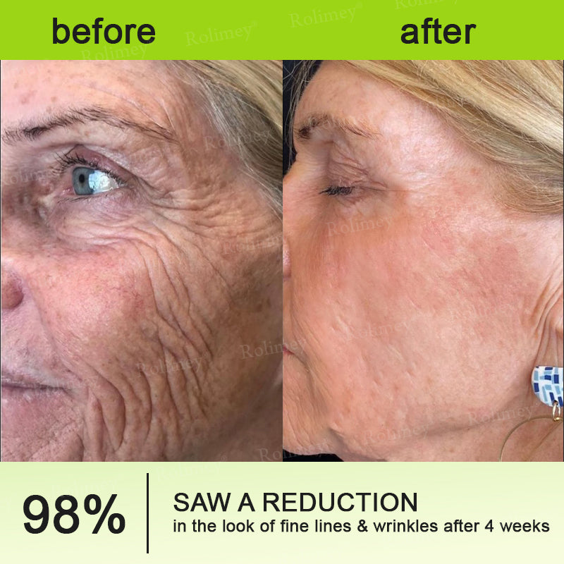 🇨🇦 Proudly Formulated & Shipped from Canada🍁Rolimey® Botox & Vita-A Retinol Shot Wrinkle-Lift Tightening Cream Last Day Promotion: 50% OFF