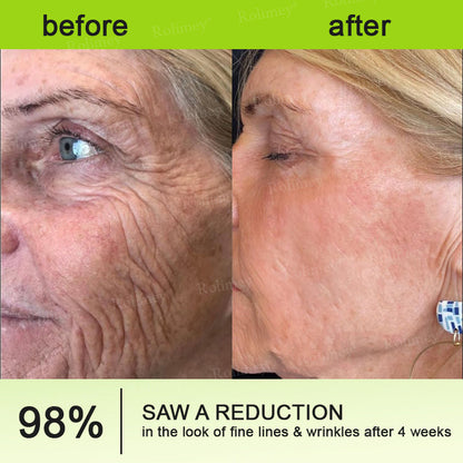 🇨🇦 Proudly Formulated & Shipped from Canada🍁Rolimey® Botox & Vita-A Retinol Shot Wrinkle-Lift Tightening Cream Last Day Promotion: 50% OFF