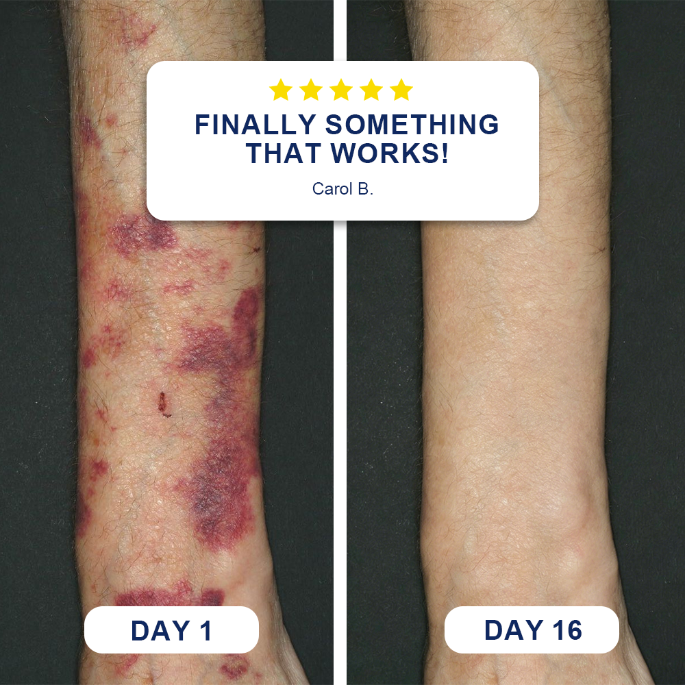 🍁Evolvion® Bruise Repair & Skin-Strengthening Cream
