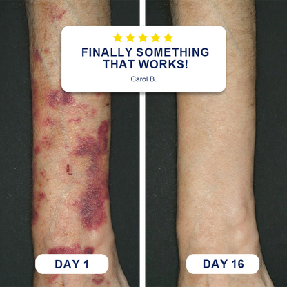 🍁Evolvion® Bruise Repair & Skin-Strengthening Cream
