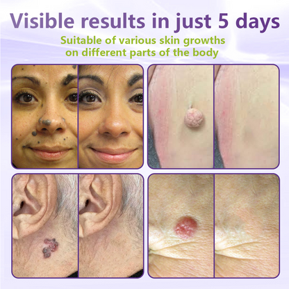 𝐎𝐟𝐟𝐢𝐜𝐢𝐚𝐥 𝐒𝐭𝐨𝐫𝐞 🇨🇦 |🍁💖💕GFOUK® Soluble Microneedle Botanical Skin Tag Removal Patch