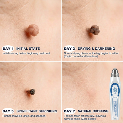 ✨🍁Evolvion® 𝟕-𝐃𝒂𝘆 𝐒𝗸𝐢𝐧 𝐓𝒂𝗴 & 𝐒𝐩𝙤𝐭 𝐄𝐫𝒂𝐬𝙚𝐫 Painless & Scar-Free Advanced Imperfection Remova𝗜 Ro𝗜𝗜erba𝗜𝗜 Pen