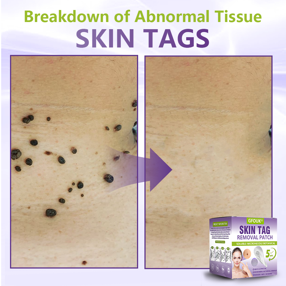 𝐎𝐟𝐟𝐢𝐜𝐢𝐚𝐥 𝐒𝐭𝐨𝐫𝐞 🇨🇦 |🍁💖💕GFOUK® Soluble Microneedle Botanical Skin Tag Removal Patch