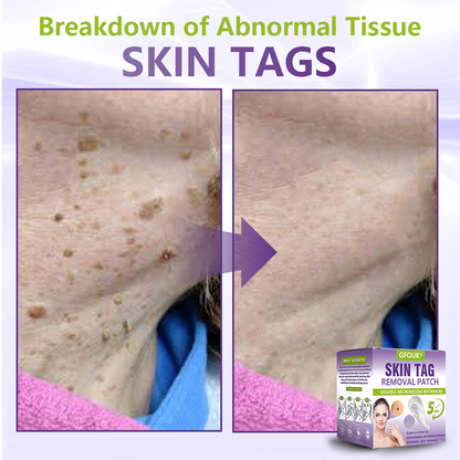 𝐎𝐟𝐟𝐢𝐜𝐢𝐚𝐥 𝐒𝐭𝐨𝐫𝐞 🇨🇦 |🍁💖💕GFOUK® Soluble Microneedle Botanical Skin Tag Removal Patch