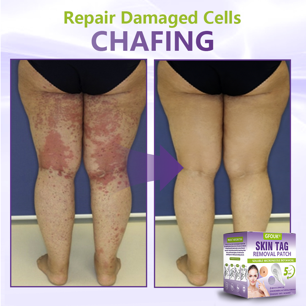 𝐎𝐟𝐟𝐢𝐜𝐢𝐚𝐥 𝐒𝐭𝐨𝐫𝐞 🇨🇦 |🍁💖💕GFOUK® Soluble Microneedle Botanical Skin Tag Removal Patch
