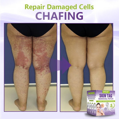 𝐎𝐟𝐟𝐢𝐜𝐢𝐚𝐥 𝐒𝐭𝐨𝐫𝐞 🇨🇦 |🍁💖💕GFOUK® Soluble Microneedle Botanical Skin Tag Removal Patch