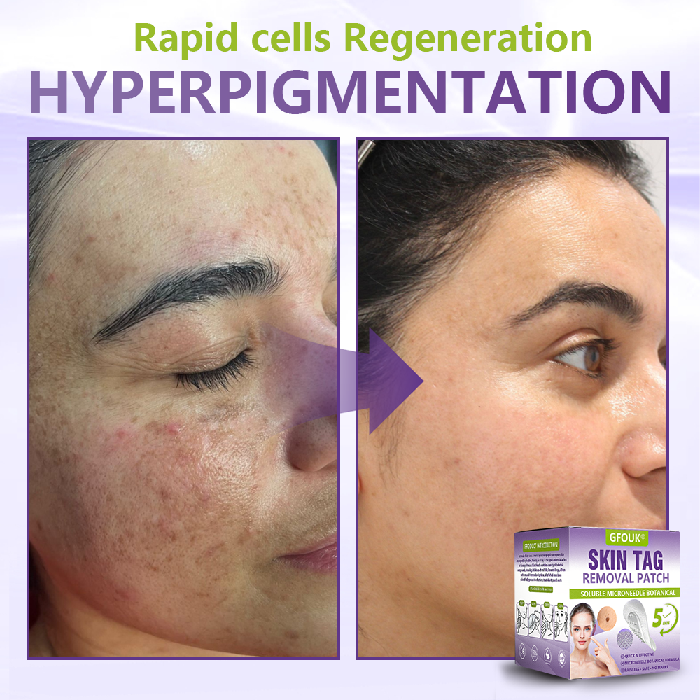 𝐎𝐟𝐟𝐢𝐜𝐢𝐚𝐥 𝐒𝐭𝐨𝐫𝐞 🇨🇦 |🍁💖💕GFOUK® Soluble Microneedle Botanical Skin Tag Removal Patch