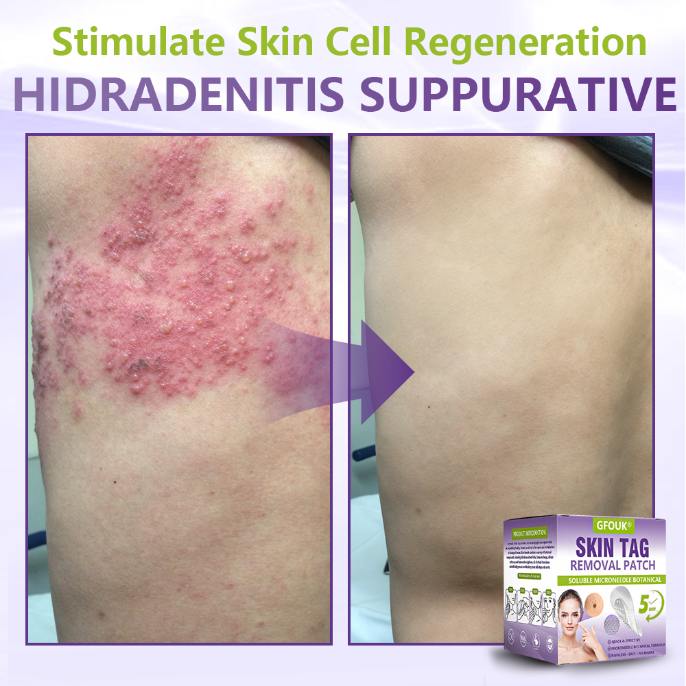 𝐎𝐟𝐟𝐢𝐜𝐢𝐚𝐥 𝐒𝐭𝐨𝐫𝐞 🇨🇦 |🍁💖💕GFOUK® Soluble Microneedle Botanical Skin Tag Removal Patch