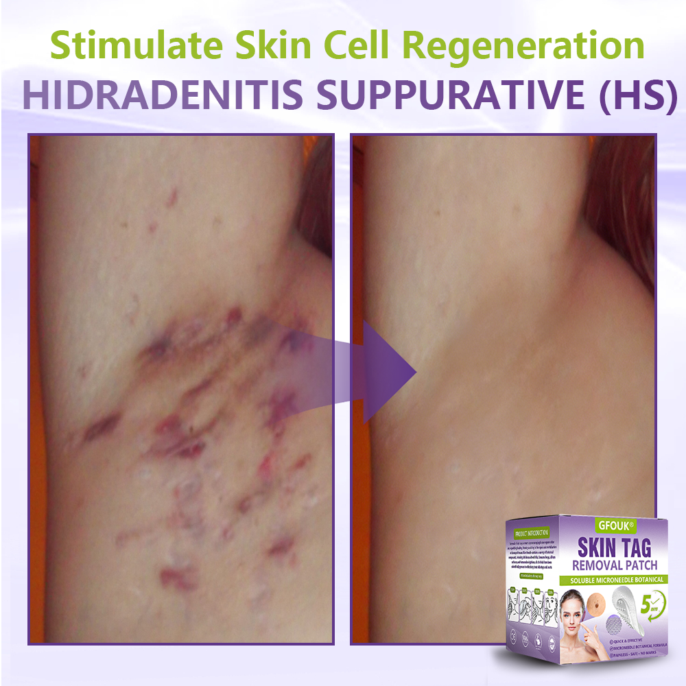 𝐎𝐟𝐟𝐢𝐜𝐢𝐚𝐥 𝐒𝐭𝐨𝐫𝐞 🇨🇦 |🍁💖💕GFOUK® Soluble Microneedle Botanical Skin Tag Removal Patch