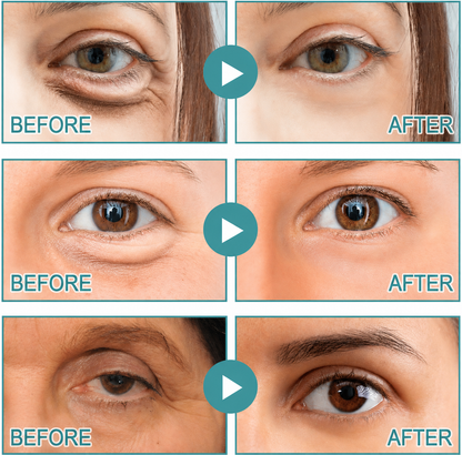 LAST DAY - BUY 1 GET 1 FREE🍁Toclvo® Dissolving Microneedle Eye Patches